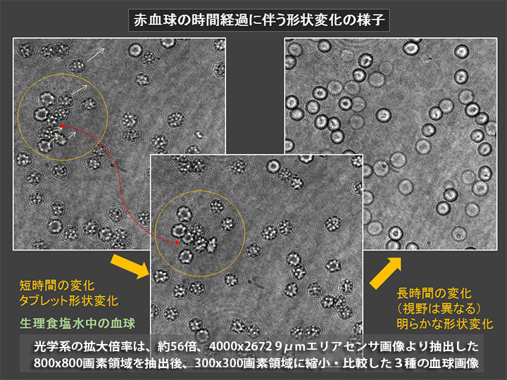 血球形状の変化の画像